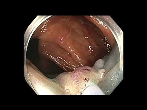 Coloscopie : mucosectomie endoscopique d'un polype festonné sessile du côlon ascendant attaché au mur