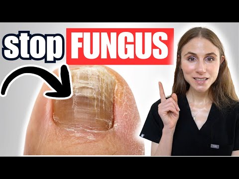 How to Treat and Prevent Toenail Fungus at Home (Step-by-Step)