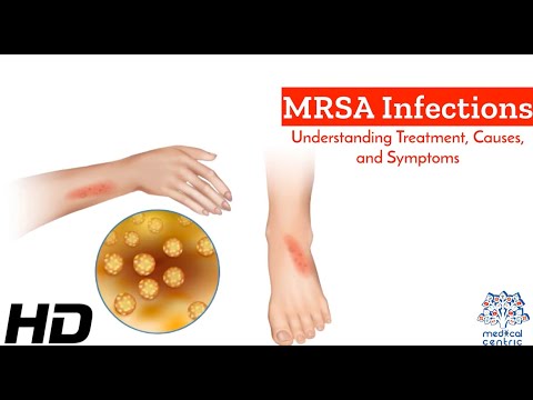 MRSA Unmasked: A Comprehensive Guide to Causes, Symptoms, and Treatment