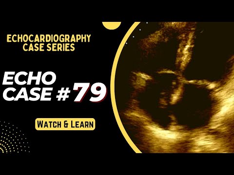 Echocardiography Case 79 | Echo Spot Diagnosis Series | Echo Made Easy
