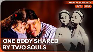 The Real Lives of History’s Most Famous Conjoined Twins | Medical Incredible