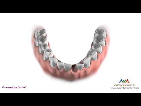 Orthodontic Treatment for Severe Crowding - Removing 1 Lower Front Tooth