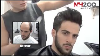 Hair Replacement FITTING VIDEO (Sam) – Hair loss, Baldness, Hair Wigs, Hair Toupees, Hair pieces