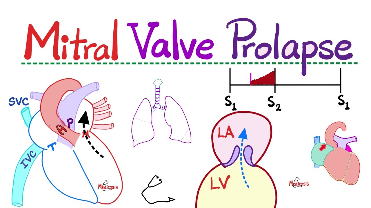 Mitral Valve Prolapse (MVP) - Mitral Regurgitation (MR) - Valvular Heart Disease (VHD) - Cardiology🫀