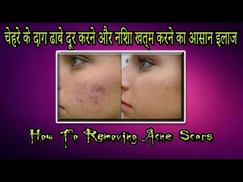 How To Removing Acne Scars / चेहरे के दाग ढाबे दूर करने और निशा खत्म करने का आसान इलाज  In urdu/Hin