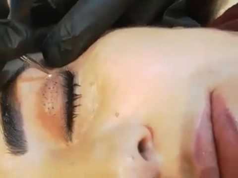 PlaCo-Der Plasma Pen!