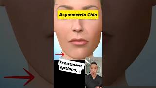 Asymmetric Chin? Here’s How to Correct It! #dentallan #dentist #shorts