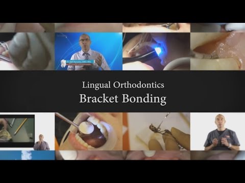 Dr. Rafi Romano - Lingual Orthodontics -Bracket bonding