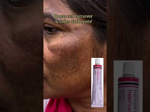 Tretinoin 0.05% Cream | Clear Skin Secret! & Melasma #Tretinoin #Pigmentation #Melasma