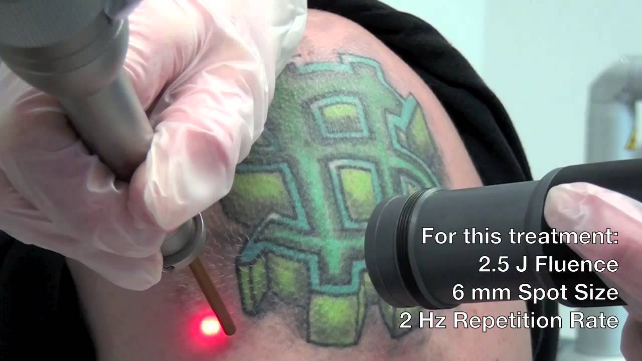 Q-Switched Ruby Laser -- Astanza Eternity Tattoo Removal Laser