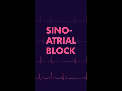 Sinus Block - Cardiac Rhythm (EKG)