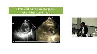 Future of Cardiac Transplantation – Dr Kavitha Muthiah
