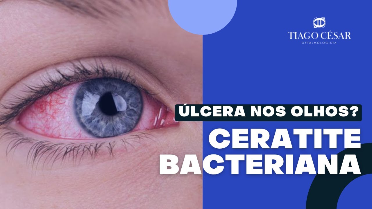 ÚLCERA NOS OLHOS | Ceratite bacteriana | Úlcera de córnea