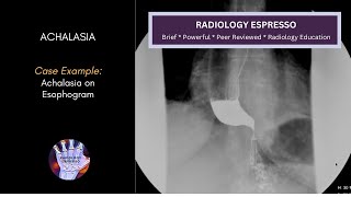 ACHALASIA: Case Example - ACHALASIA of an Esophagram (4630)