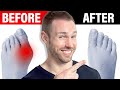 How to Fix Bunions Naturally [No Surgery Needed]