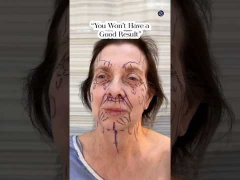 Natural Results| Facelift 2 Months Post-Op| Before and After