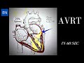 Atrioventricular Reentrant Tachycardia (AVRT): Animation and ECG #Shorts