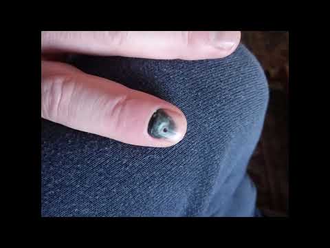 20 week time lapse of finger nail falling off.