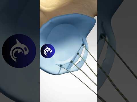 See how a Bankart Lesion of the Shoulder is repaired in 3D animation