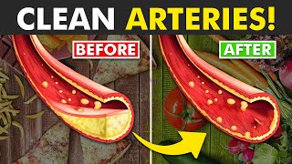 Unclog Your Arteries Without surgery! (Must Try)