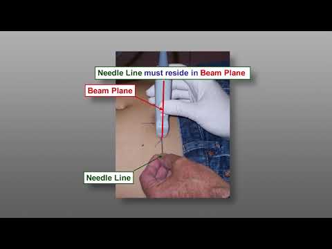 Fine Needle Aspiration Biopsy (FNA) Techniques - Ultrasound Guided FNA The Parallel Approach