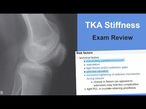 TKA Stiffness Exam Review - Thomas Sculco, MD