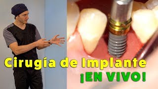 Cirugía de IMPLANTE DENTAL EN VIVO. Cómo se coloca, procedimiento completo.
