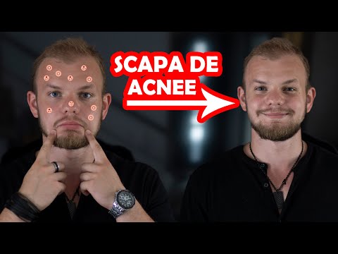 preul de tratament cu varicoza comprima de la picioarele varicoase