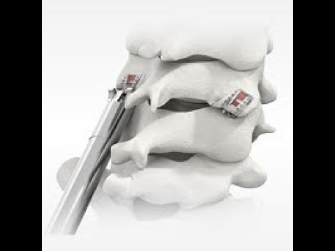 Providence Medical Technology: CAVUX FFS