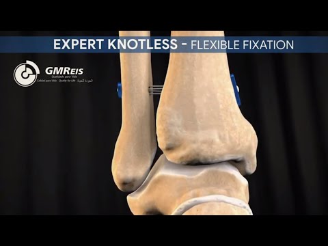 3D Animation: Expert Knotless - Flexible Fixation