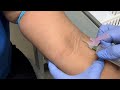 HOW TO REDIRECT THE NEEDLE  TOWARDS THE VEIN AFTER MISSING THE VEIN(NO TALKING)