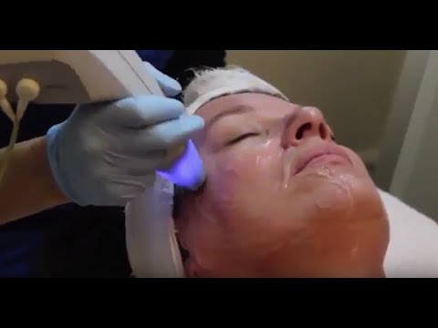 Exilis Elite Facial Skin Tightening | Clarity MedSpa