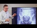 Ganz Osteotomy Surgery  - What to Expect
