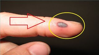 how to get rid of a blood blister that won
