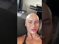 WHAT IN THE ALOPECIA IS GOING ON Hairgrowth Alopecia Alopeciaawareness Bald Hairregrowth