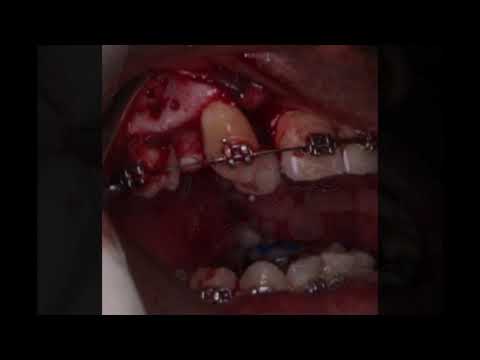 Invisalign Review