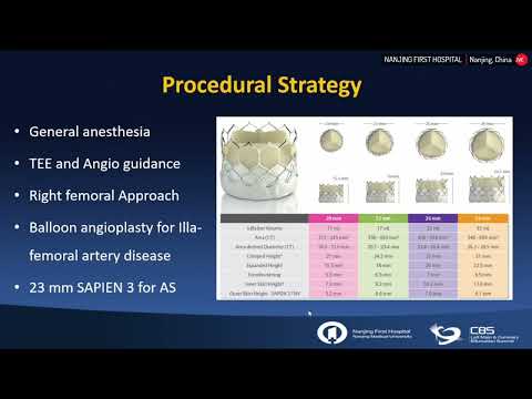 TAVI Using a 23mm Sapien 3 Valve