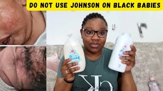 How I cleared my baby's Rash Eczema in 1 month | Do not use Johnson baby products on black babies