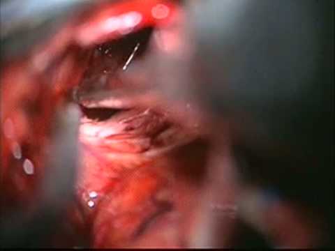 Anterior transcallosal approach to the 3rd ventricle
