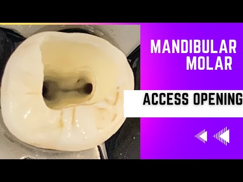 Mandibular Molar Access Opening