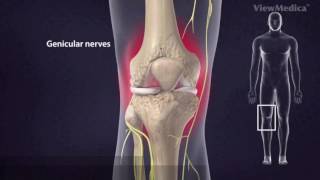 Radiofrecuencia en Nervios Geniculados de Rodilla
