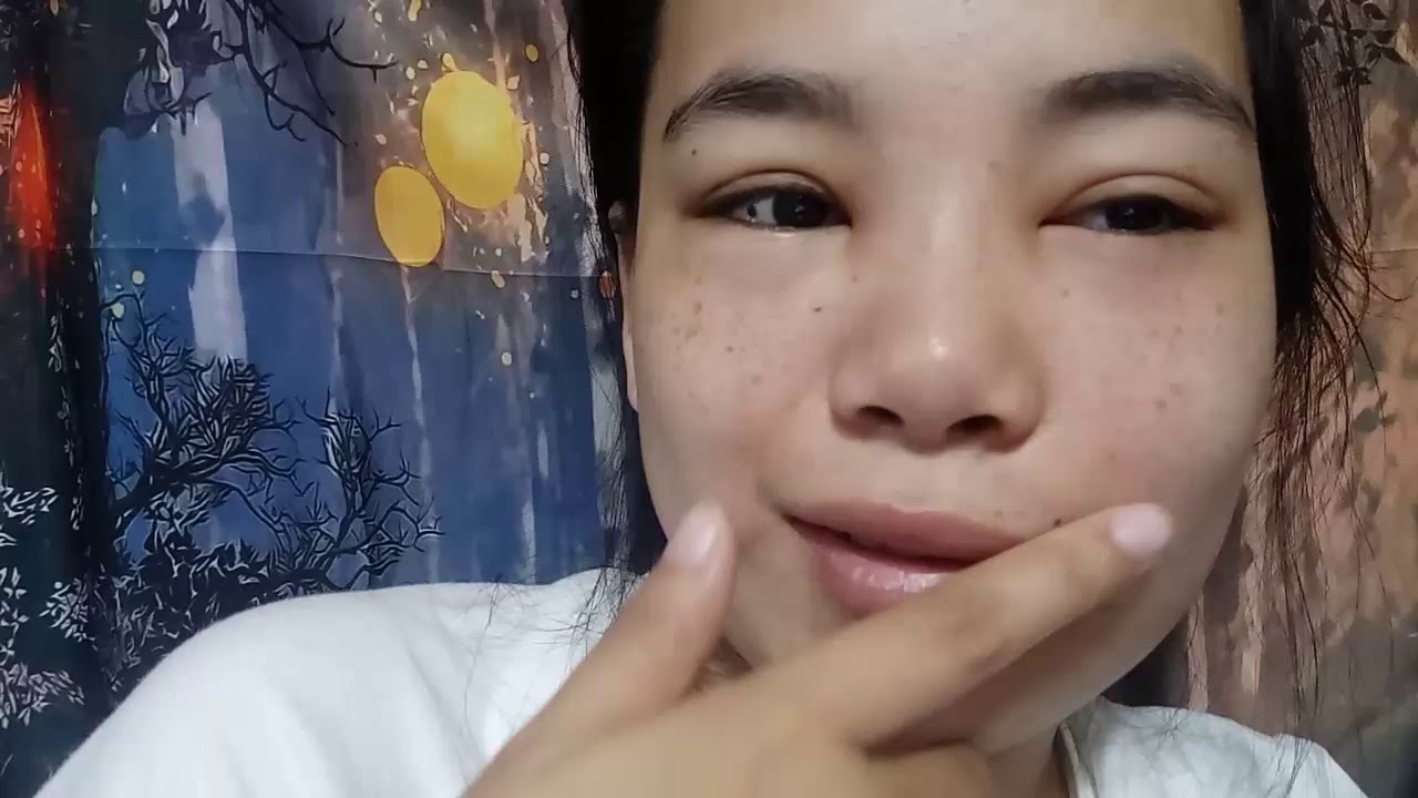 Swollen Face (Namamagang Mukha) 2nd 3rd and 4th day update