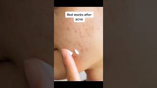 Banishing Red Marks How to Get Rid of Post-Acne Hyperpigmentation#viral #medical #skincare