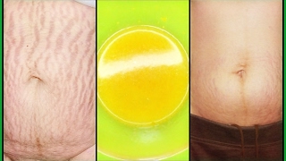 USE THIS POWERFUL HOMEMADE TREATMENT TO ERASE STRETCH MARKS NATURALLY |Khichi Beauty