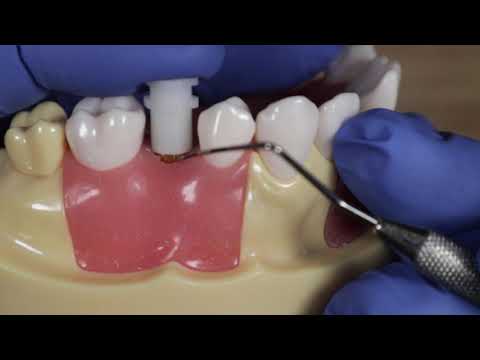 Closed Tray Impression Coping - How to Take A Closed Tray Impression
