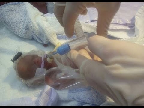 Fille née de la taille d'une cuillère à soupe quitte l'hôpital après un combat de survie miraculeux Video