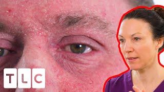 Agressive Eczema Is Ruining His Life | Bad Skin Clinic