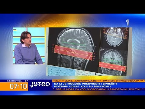 JUTRO - Uglavnom se dešava ujutru i ostavlja trajne posledice: Najčešći simptomi moždanog udara