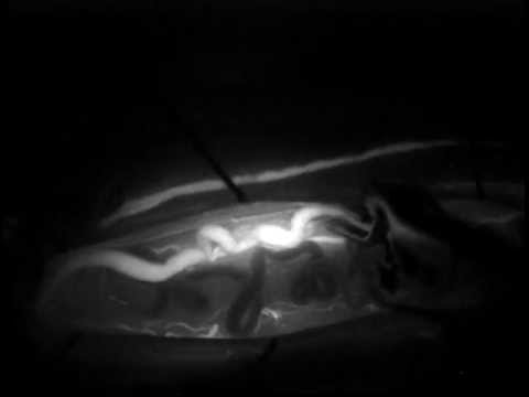 Thoracic spinal dAVF video angiography