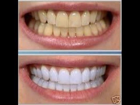 Olio di sesamo pigmentary posti La decolorazione efficace affronta pacchi da lentiggini